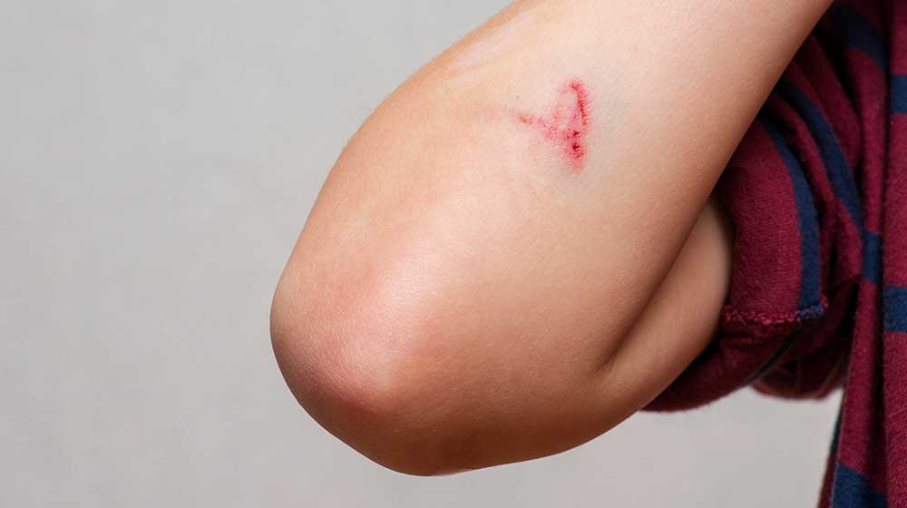 Deep-scratches-on-the-skin-with-bruises | feature | The Wound Healing Effects Of BPC-157 Discussed