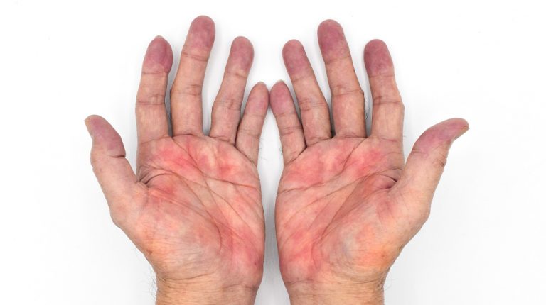 PH-Palmar erythema often called liver palms in both hands-ss-What Causes Palmar Erythema and What Does It Mean for Your Health